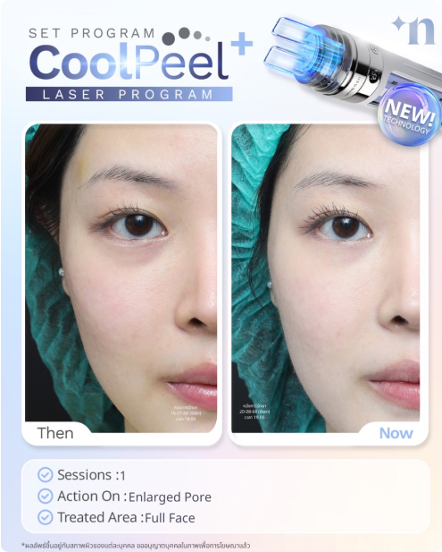 Coolpeel Full Face